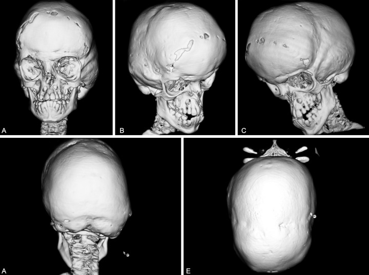 Crouzon-skull-scan
